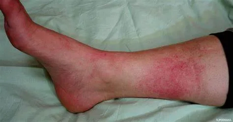 تجربتي مع جميع طرق علاج مرض الحمرة بالساق