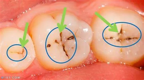 ماهي طرق إزالة التسوس من الأسنان؟! أفضل طرق علاج تسوس الأسنان
