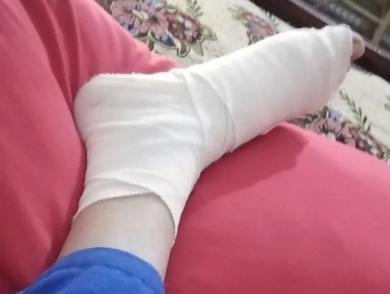 تفسير رؤية كسر الرجل في المنام