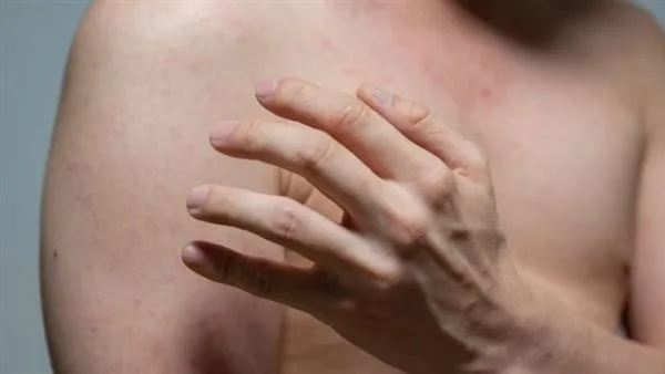 تحذيرات من توطن مرض الحصبة في الولايات المتحدة بسبب تراجع معدلات التطعيم تحذيرات من توطن مرض الحصبة في الولايات المتحدة بسبب تراجع معدلات التطعيم