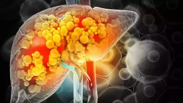 دراسة: دواء جديد يحقق نتائج مذهلة في علاج الكبد الدهني