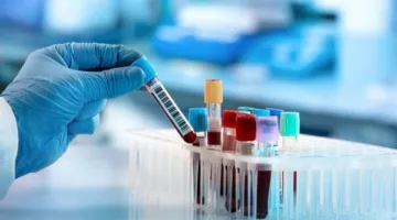 أطباء بريطانيا: اختبار دم جديد للكشف عن 12 نوعًا من السرطان بدقة تصل إلى 99%