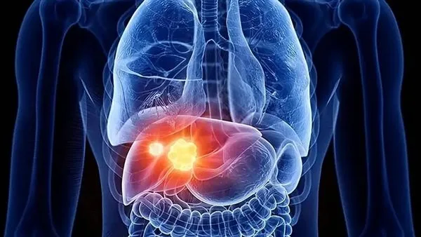 تحذير طبي: سرطان الكبد قد يصيبك في العشرينات.. وهذه العادات السبب تحذير طبي: سرطان الكبد قد يصيبك في العشرينات.. وهذه العادات السبب