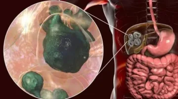 دراسة تحذر من الإصابة بنوع من الطفيليات تسبب فشل الكبد