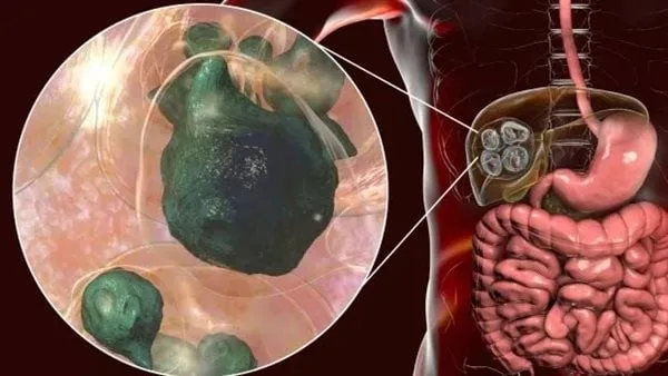 دراسة تحذر من الإصابة بنوع من الطفيليات تسبب فشل الكبد دراسة تحذر من الإصابة بنوع من الطفيليات تسبب فشل الكبد