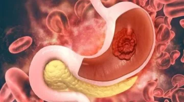 دراسة تحذر من علامة خطيرة للإصابة بـ سرطان المعدة
