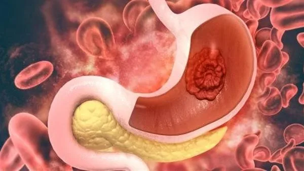 دراسة تحذر من علامة خطيرة للإصابة بـ سرطان المعدة دراسة تحذر من علامة خطيرة للإصابة بـ سرطان المعدة