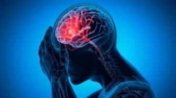 دراسة حديثة: تلوث البلاستيك الدقيق في الدم مرتبط بزيادة خطر السكتات الدماغية