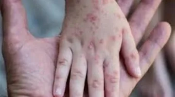 مستشار الرئيس للصحة: لم نرصد أي حالات إصابة بالجدري المائي أعراضها غير المعتاد