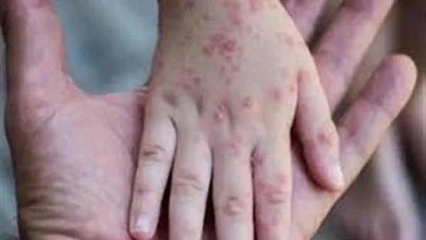 مستشار الرئيس للصحة: لم نرصد أي حالات إصابة بالجدري المائي أعراضها غير المعتاد مستشار الرئيس للصحة: لم نرصد أي حالات إصابة بالجدري المائي أعراضها غير المعتاد