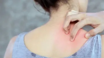 أمراض جلدية مرتبطة بالطقس الحار.. تعرف عليها