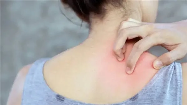 أمراض جلدية مرتبطة بالطقس الحار.. تعرف عليها أمراض جلدية مرتبطة بالطقس الحار.. تعرف عليها