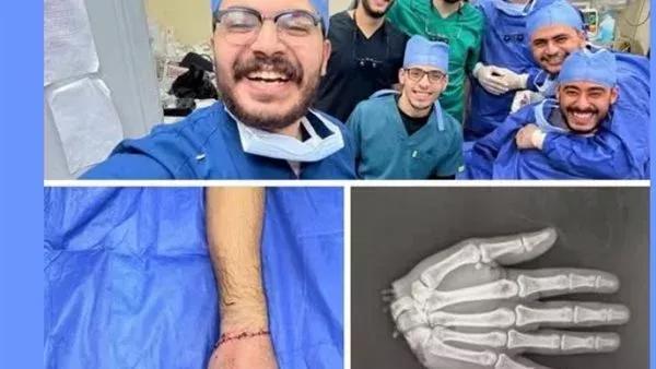 كنا 10 أطباء واستغرقنا 12 ساعة.. أول تعليق من دكتور بطب الأزهر نجح في إعادة يد شاب بعد بترها بالكامل 