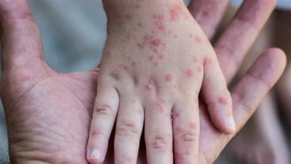 بعد أمريكا.. انتشار الحصبة في مقاطعة بريطانية بعد أمريكا.. انتشار الحصبة في مقاطعة بريطانية