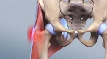 أبرزها ألم الركبة.. أعراض متلازمة الألم الرضفي الفخذي