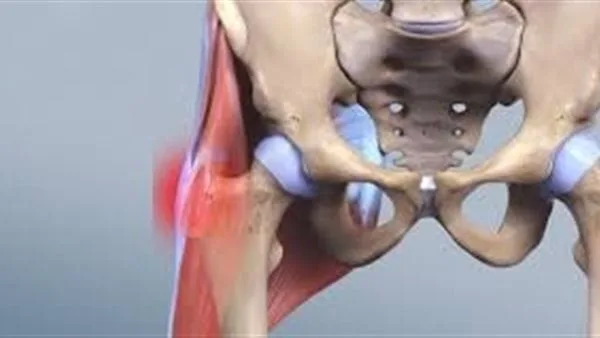 أبرزها ألم الركبة.. أعراض متلازمة الألم الرضفي الفخذي