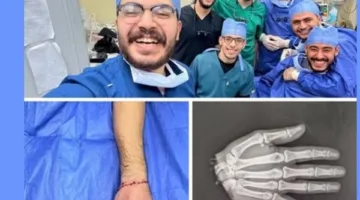 استغرقت 12 ساعة.. فريق طبي بطب الأزهر ينجح في إعادة يد شاب بعد بترها الكامل