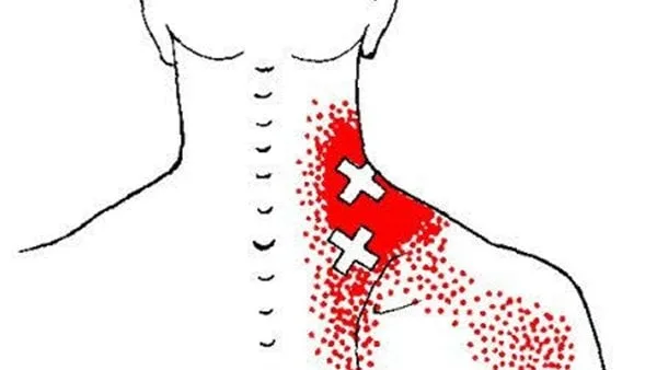 تَحدث نتيجة الإفراط في استخدام العضلات.. ما هي العقد العضلية؟ تَحدث نتيجة الإفراط في استخدام العضلات.. ما هي العقد العضلية؟