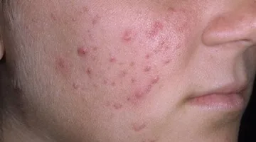 خطوات بسيطة لحماية البشرة والعينين من العواصف الترابية.. تعرف عليها