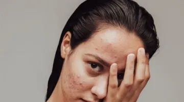 دراسة: حب الشباب يضاعف خطر الإصابة باضطرابات الأكل لدى البالغين