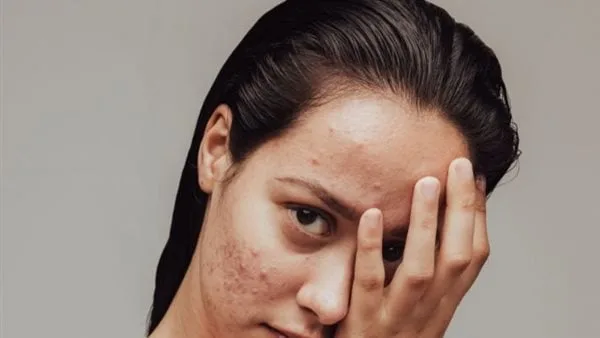 دراسة: حب الشباب يضاعف خطر الإصابة باضطرابات الأكل لدى البالغين