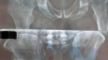 فريق طبي بمستشفى الخانكة ينجح في إجراء 30 عملية تغيير مفصل صناعي