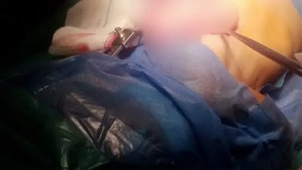 لديه 3 فصوص بالرئة.. إنقاذ حياة رضيع يعاني من عيب خلقي بمستشفى قنا الجامعي لديه 3 فصوص بالرئة.. إنقاذ حياة رضيع يعاني من عيب خلقي بمستشفى قنا الجامعي