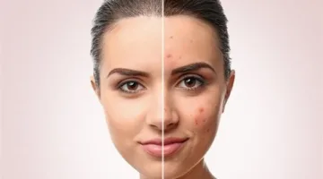 نصائح للوقاية من ظهور حب الشباب في الصيف