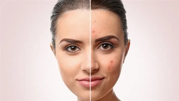 نصائح للوقاية من ظهور حب الشباب في الصيف