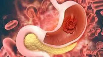 للكشف المبكر عن سرطان المعدة.. دراسة تكشف تطور أدوات فحص الجهاز الهضمي
