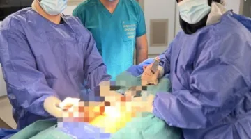 للمرة الأولى في مصر.. فريق طبي بجامعة المنصورة يُجري جراحة نادرة للحفاظ على خصوبة مريضات السرطان