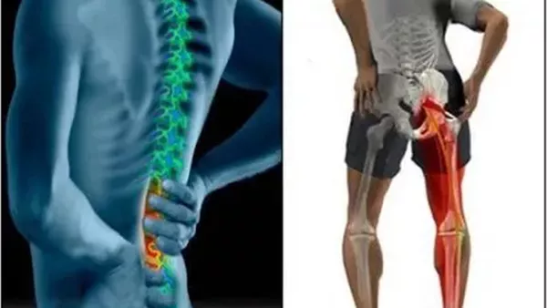 ينتج عن تمزق أحد الغضاريف.. تعرف على أسباب الإصابة بعرق النسا