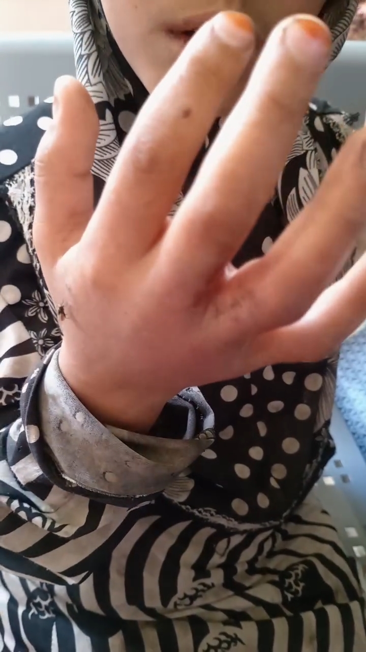 الطفلة ضحية تعذيب والدها في الوادى الجديد