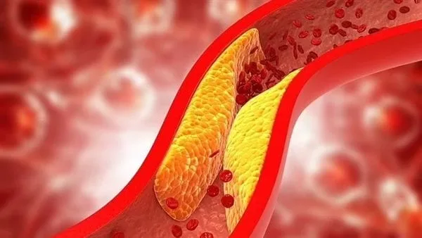 أخطاء شائعة ترفع مستوى الكوليسترول دون أن تدري..تعرف على التفاصيل