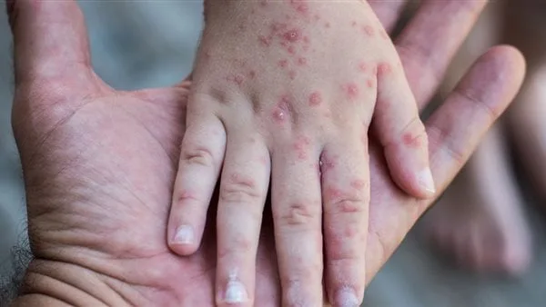 ارتفاع حالات الإصابة بالجدري في مالاوي.. وتفاقم المخاوف من تفشي المرض