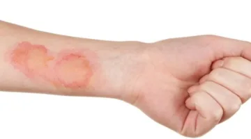 ارتفاع مقلق بإصابات سرطان الجلد في كندا وسط تراجع استخدام واقي الشمس