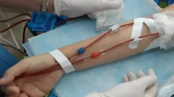 الصحة: تنفيذ أكثر من مليون و600 ألف جلسة غسيل كلوي مميكنة حتى الآن