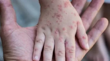 بريطانيا تغير خطط التطعيمات وسط مخاوف من ارتفاع حالات الإصابة بالحصبة