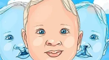 عدم التحام أنسجة الشفة العليا.. متى يصاب الطفل بالشفة الأرنبية؟