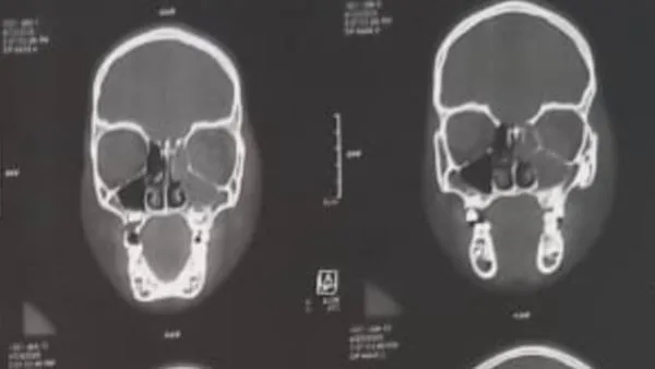 فريق طبي بجامعة أسيوط ينقذ بصر طفل يعاني من خراج خطير بالعين| صور فريق طبي بجامعة أسيوط ينقذ بصر طفل يعاني من خراج خطير بالعين| صور